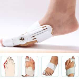 κότσι θεραπεία, hallux valgus, bunion